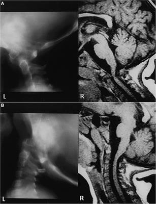 Os odontoideum: database analysis of 260 patients regarding etiology, associated abnormalities, and literature review